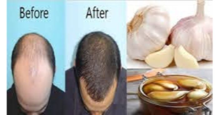 রসুন রসে নতুন চুল! রসুন রসে নতুন চুল!