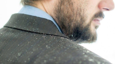 এই শীতে খুশকিমুক্ত চুল চাই? জেনে নিন কার্যকর উপায়