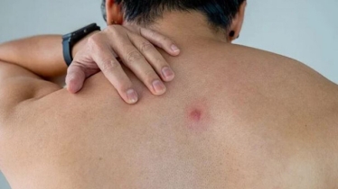 গরমকালে ত্বকে বয়েল ও কারবাংকল হওয়ার কারণ
