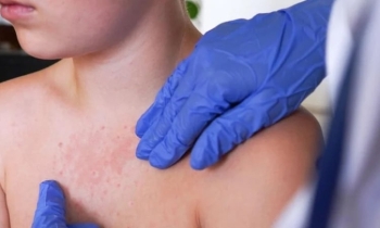 সাউথ ক্যারোলিনায় নতুন প্রাদুর্ভাব, যুক্তরাষ্ট্রে হাম বাড়ছে।