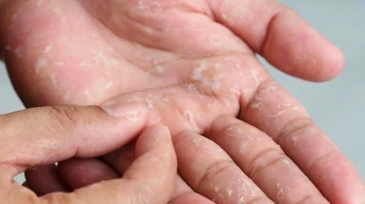 শরীরের মরা চামড়া উঠে গেলে অজু ভাঙবে?